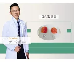 健康醫療網 | 擺脫嬰兒肥！分層口內取脂還你立體小V臉