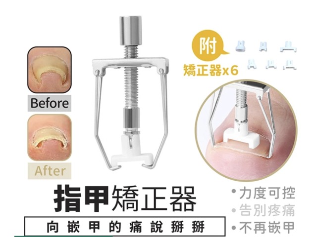 指甲護理防內長矯正器
