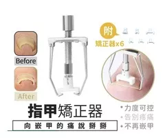 指甲護理防內長矯正器